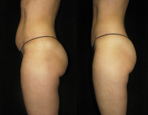 Lipo Light is the only technology that has two spectrums of light that eliminate fat and tighten the skin.  Zerona Ultraslim and other laser and laser-like fat treatments cannot deliver these results.